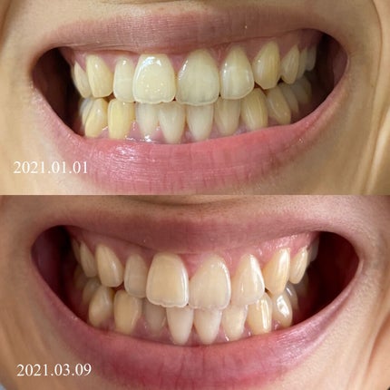 クレスト 3D ホワイトブリリアンス/クレスト/その他オーラルケアを使ったクチコミ(2枚目)