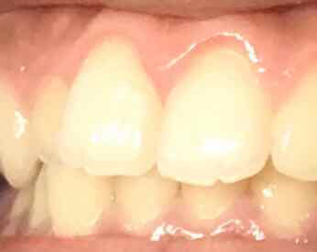 プレミアム ステインクリア ペースト/オーラツー/歯磨き粉を使ったクチコミ(3枚目)