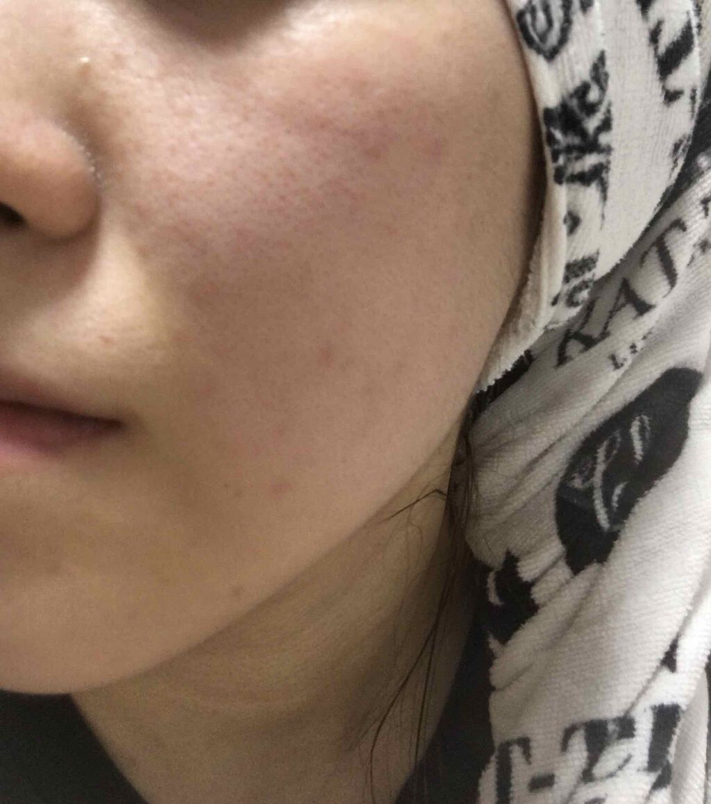 しゃんしゃん on LIPS 「結果的に言うと私的には皮膚科に行くのが一番手っ取り早いです!!..」(2枚目)