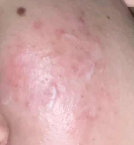 ディフェリンゲル0.1%/ガルデルマ/その他スキンケアを使ったクチコミ(1枚目)