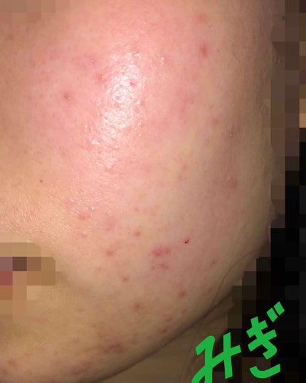 薬用 しみ 集中対策 美容液/メラノCC/美容液を使ったクチコミ(3枚目)