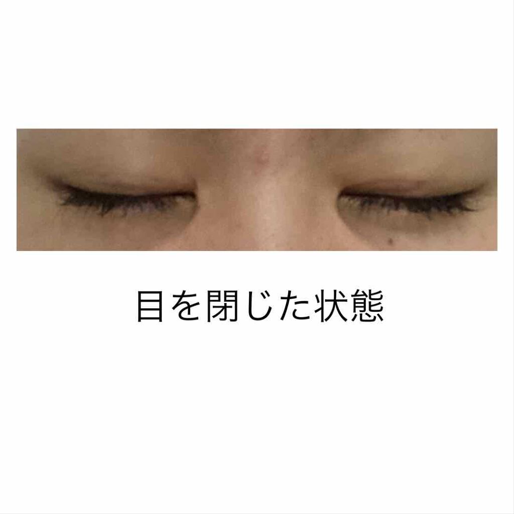 かっこいい女になりたいんだ on LIPS 「整形後、約3週間日が経つのも早くて埋没をしてから3週間が過ぎま..」(1枚目)