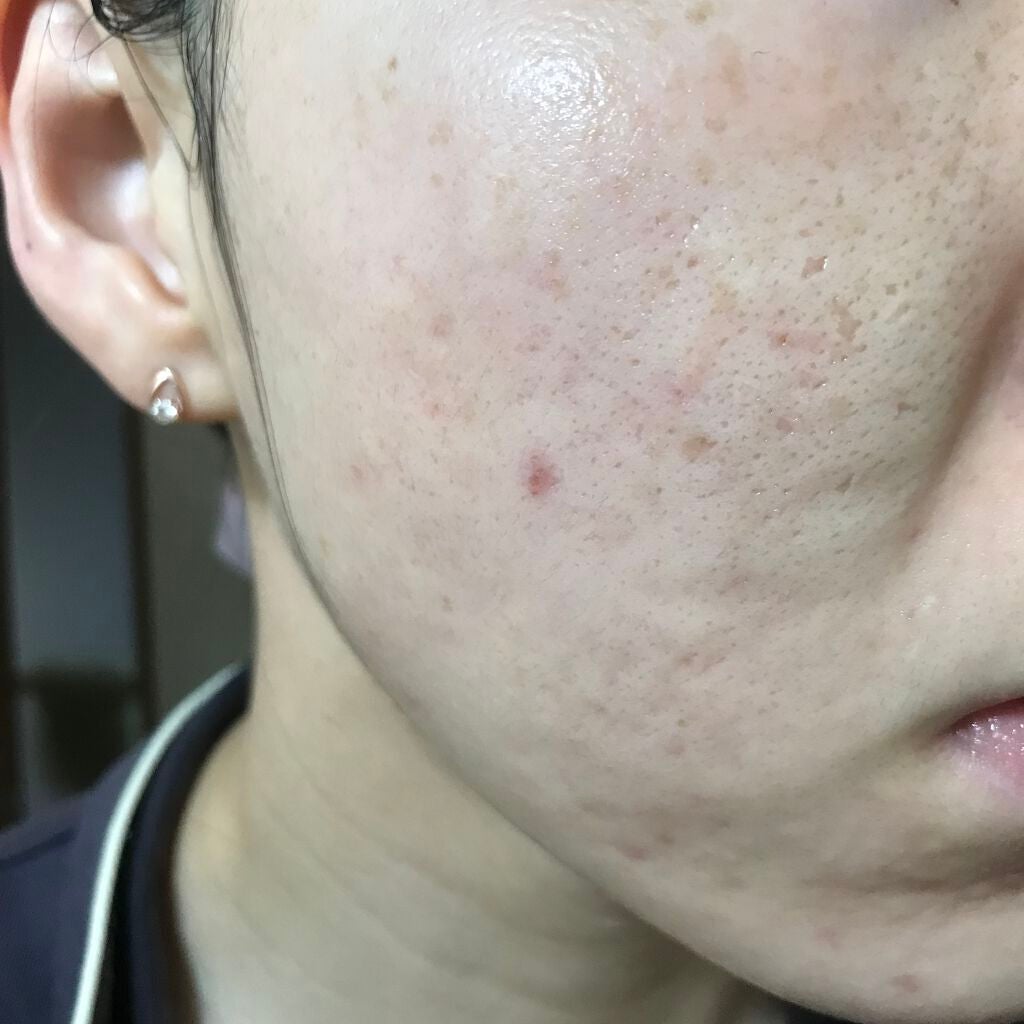 ティーツリーケア ソリューション エッセンシャルマスクEX/MEDIHEAL/シートマスク・パックを使ったクチコミ(1枚目)