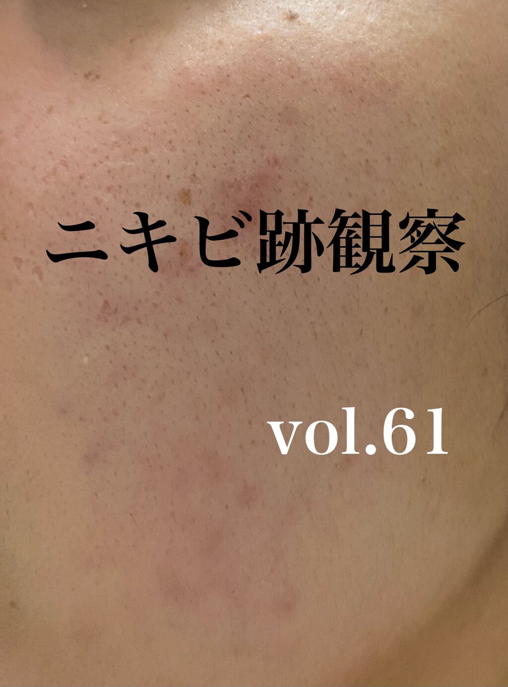 S.S.C. EPI PHOTO SKIN CARE PRO 家庭用光美容器/ミュゼコスメ/美顔器・マッサージを使ったクチコミ(1枚目)