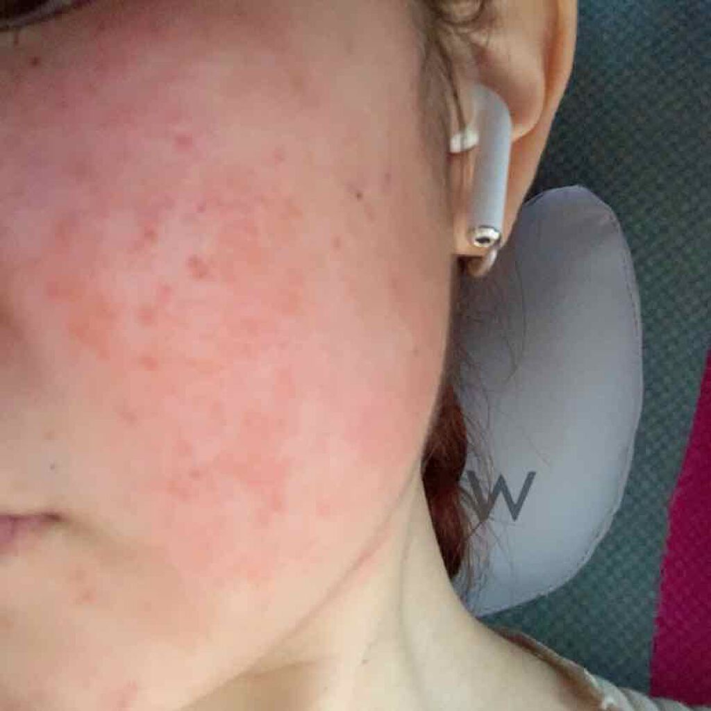 ベピオゲル/マルホ株式会社/その他を使ったクチコミ（2枚目）