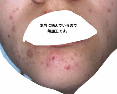 ももぷり 潤い化粧水のクチコミ「ニキビが治らなくて悩んでいます！
今までのケアや、なぜできたかなど書くので、
同じ症状の方、な.....」（2枚目）