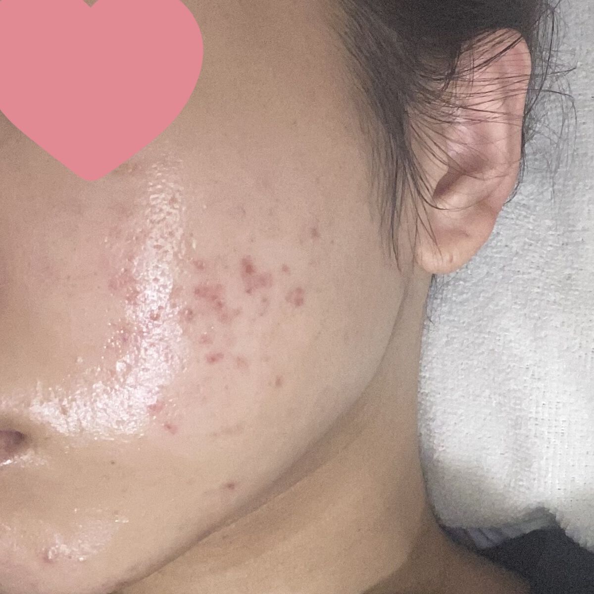 レチノールA 1% アドバンスドリバイタリゼーションクリーム/Life-flo/フェイスクリームを使ったクチコミ（1枚目）