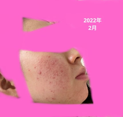 プリスクリードD(医薬品)/IHADA/その他を使ったクチコミ(1枚目)