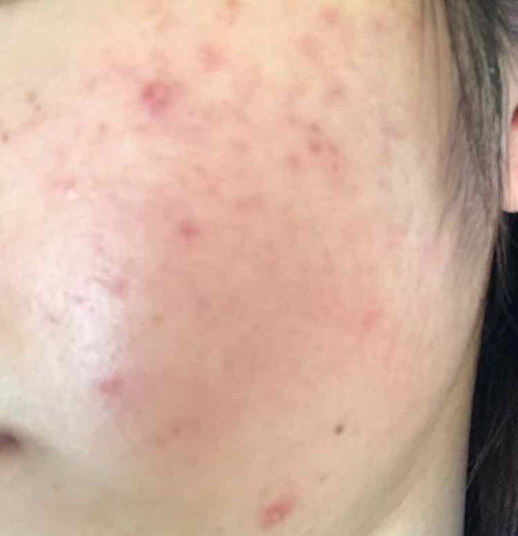 薬用保湿化粧水/オードムーゲ/化粧水を使ったクチコミ（3枚目）