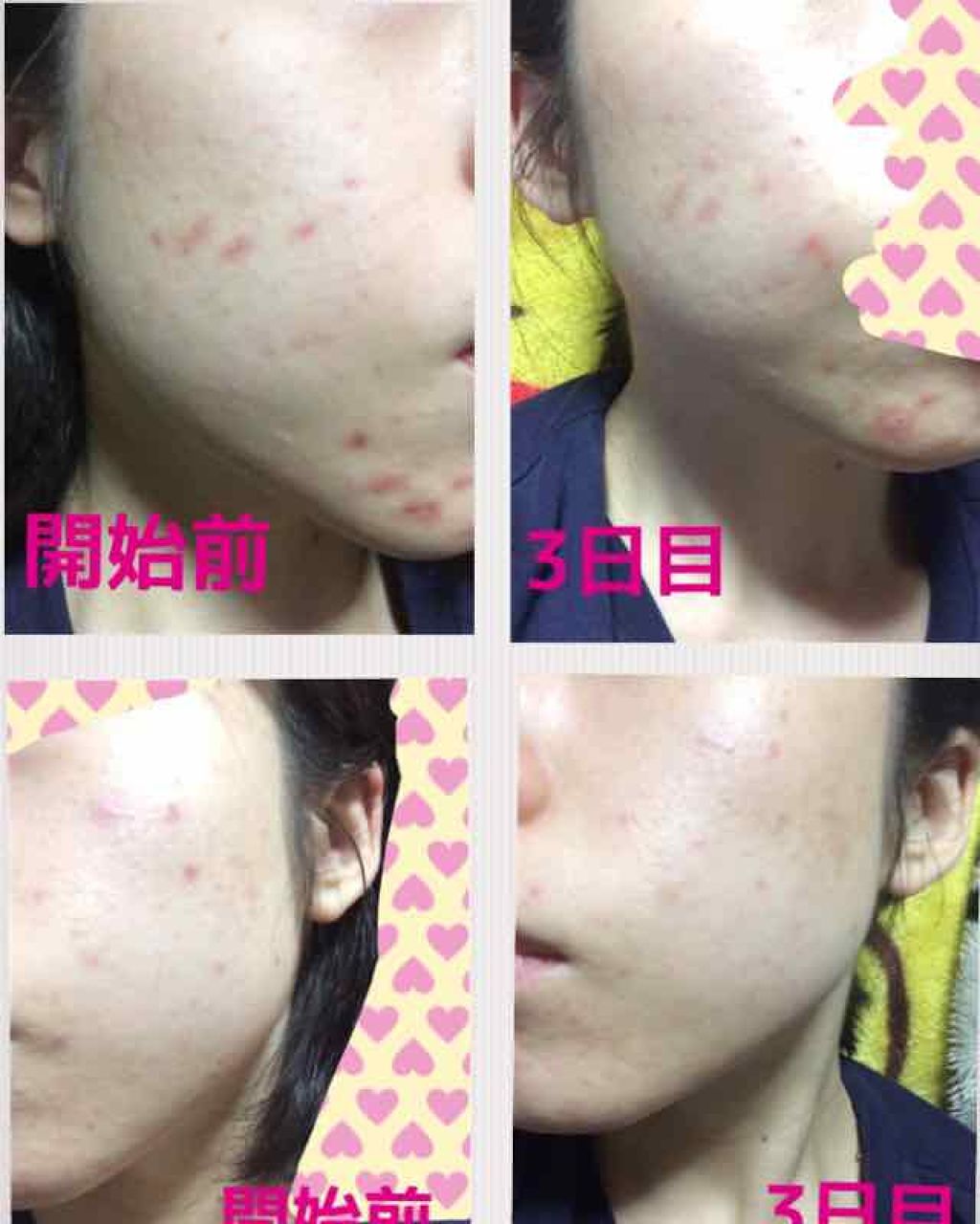 薬用 しみ 集中対策 美容液/メラノCC/美容液を使ったクチコミ（2枚目）