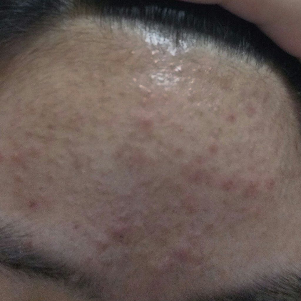 ロゼット洗顔パスタ アクネクリア/ロゼット/洗顔フォームを使ったクチコミ（2枚目）