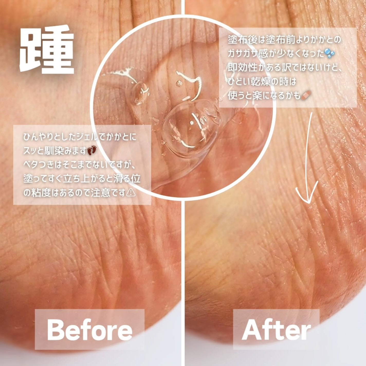 足小路麗子 薬用 フットケアジェル/ナリスアップ/レッグ・フットケアを使ったクチコミ(2枚目)