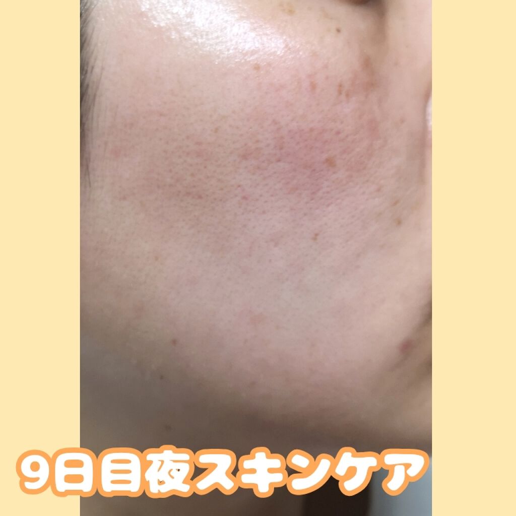 アレルバリア エッセンス BB/d プログラム/BBクリームを使ったクチコミ(4枚目)