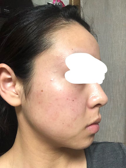 薬用しみ集中対策 プレミアム美容液/メラノCC/美容液を使ったクチコミ(1枚目)