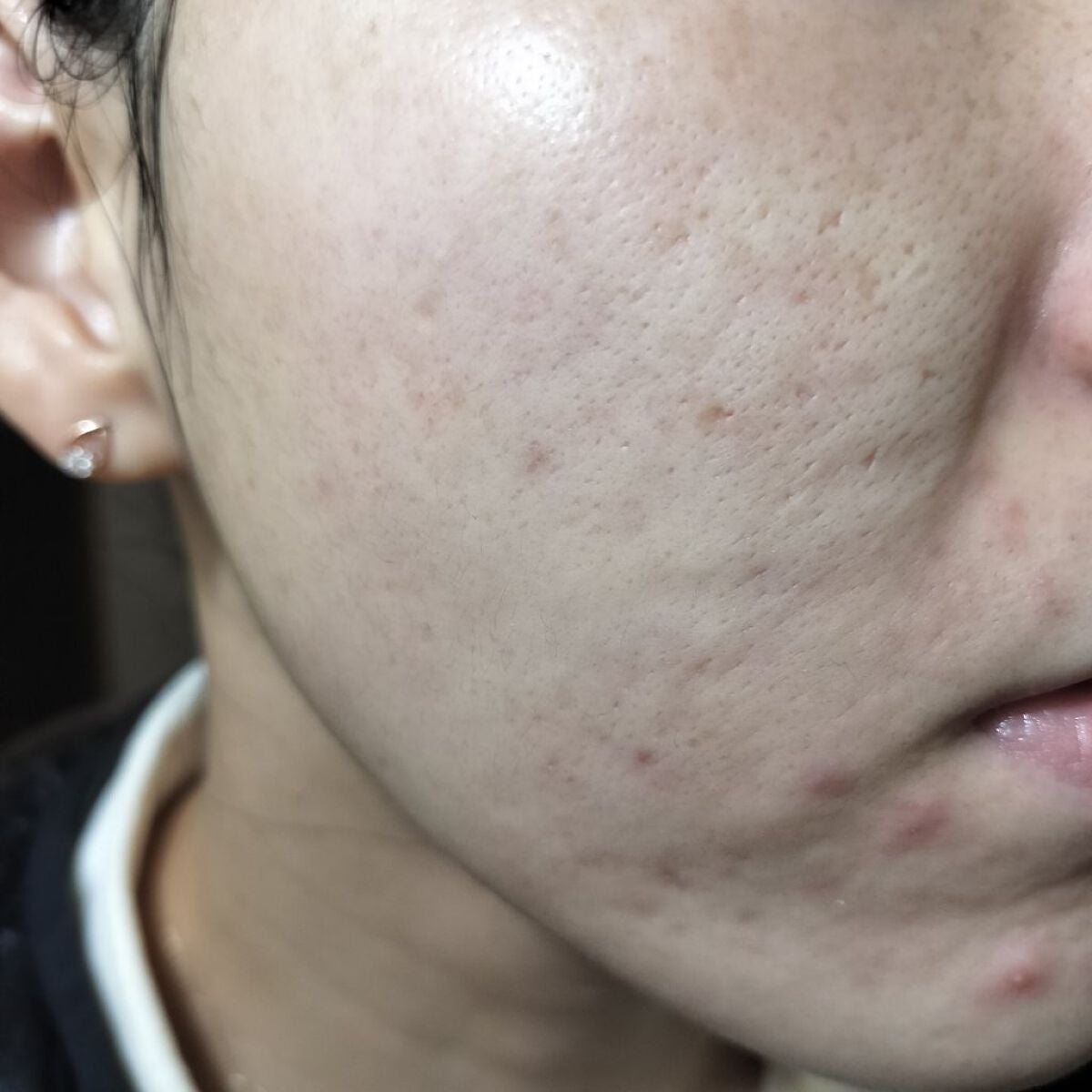 オロナインH軟膏 (医薬品)/オロナイン/その他を使ったクチコミ(1枚目)