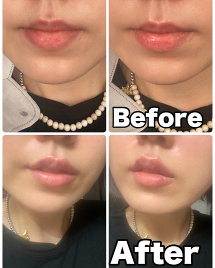 りっちゃん on LIPS 「やって良かった美容医療💉唇ヒアル💋/⚠️唇写真たくさん出ます昔..」(4枚目)