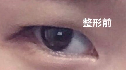 二重整形/その他を使ったクチコミ(2枚目)