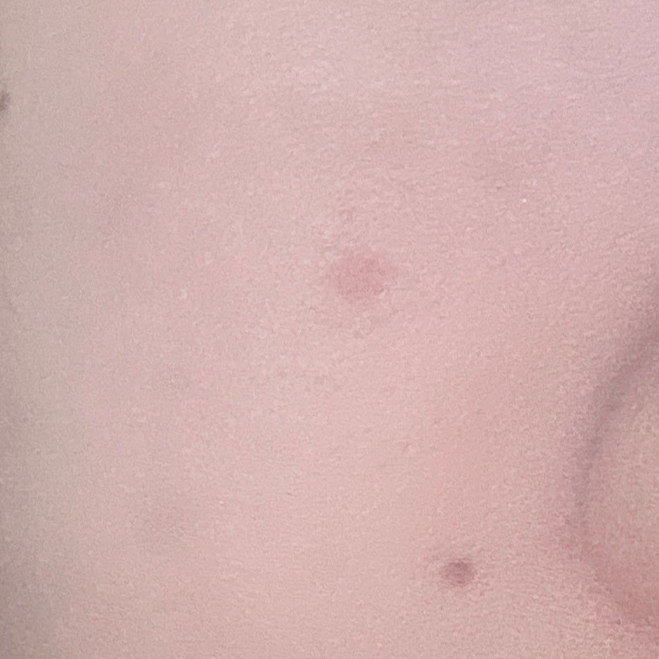 薬用コンシーラー アクネプロテクター/ONLY MINERALS/パウダーコンシーラーを使ったクチコミ(6枚目)