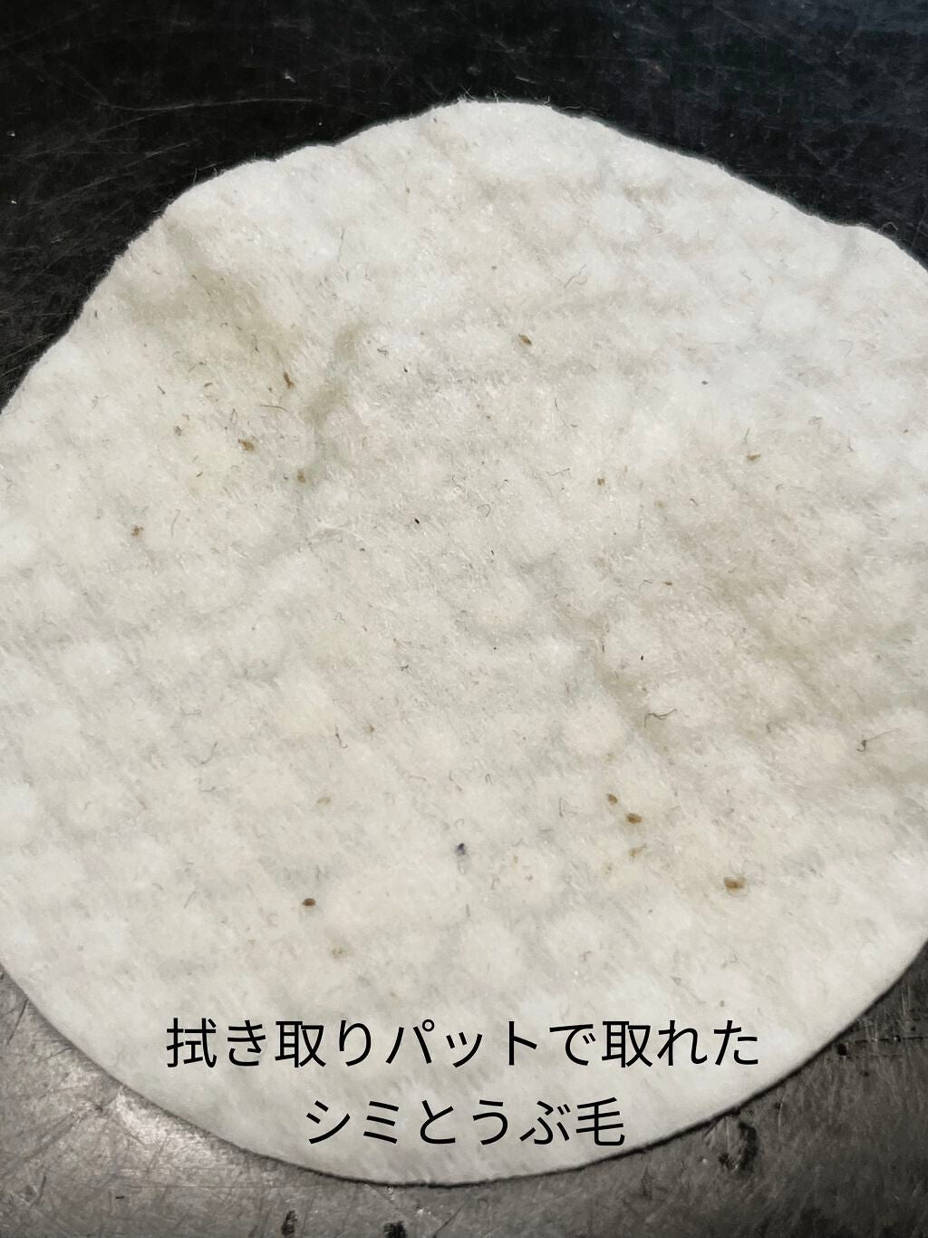 侘助 on LIPS 「【美容医療でシミ取り記録】こんにちは、侘助です❁❁❁今回は美容..」(8枚目)