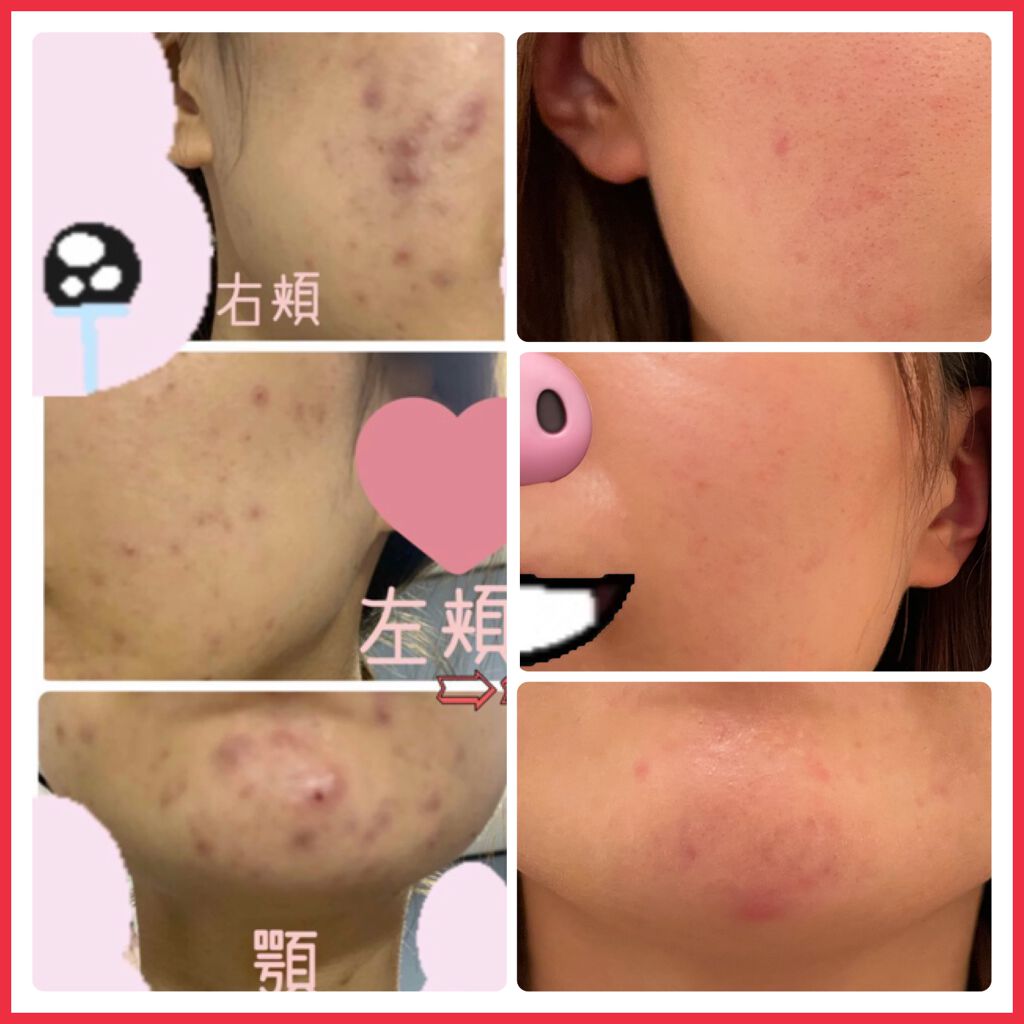 はとむぎエキス Dhcを使った口コミ ニキビ改善 ニキビが出来なくなるまでに効 By Moo 代前半 Lips