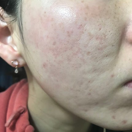 LA10+HAフェイスセラム/The Ordinary/ピーリングを使ったクチコミ(1枚目)