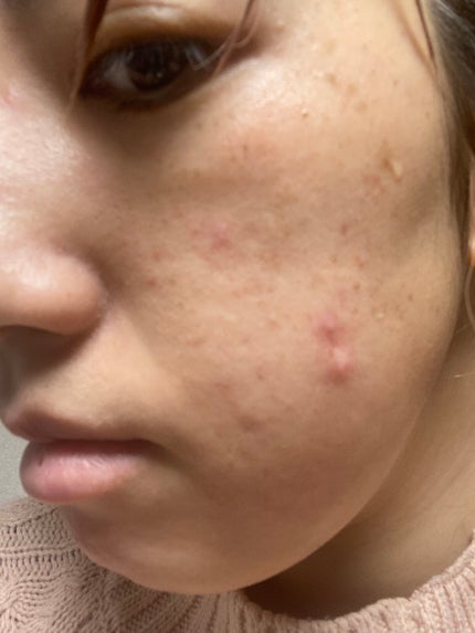 レチノールA 1% アドバンスドリバイタリゼーションクリーム/Life-flo/フェイスクリームを使ったクチコミ(2枚目)