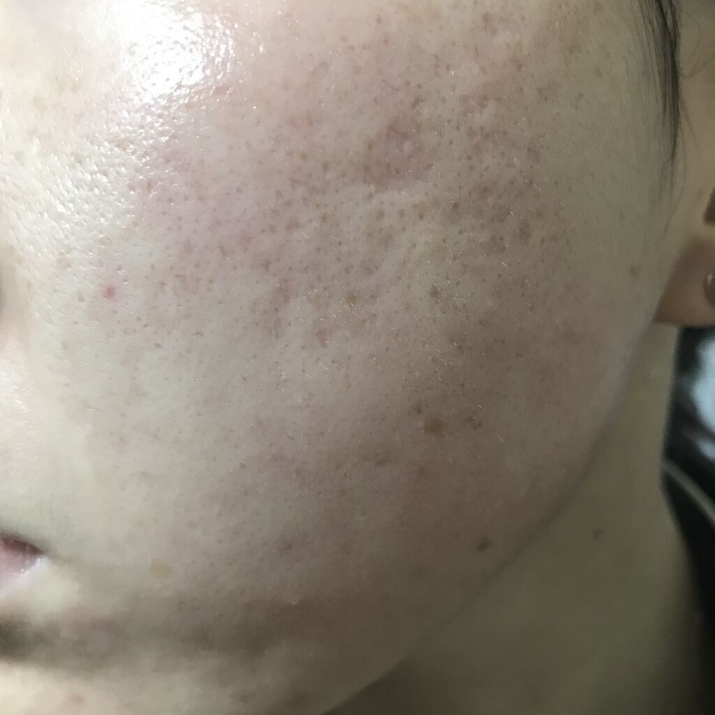 レチノールA 1% アドバンスドリバイタリゼーションクリーム/Life-flo/フェイスクリームを使ったクチコミ（2枚目）