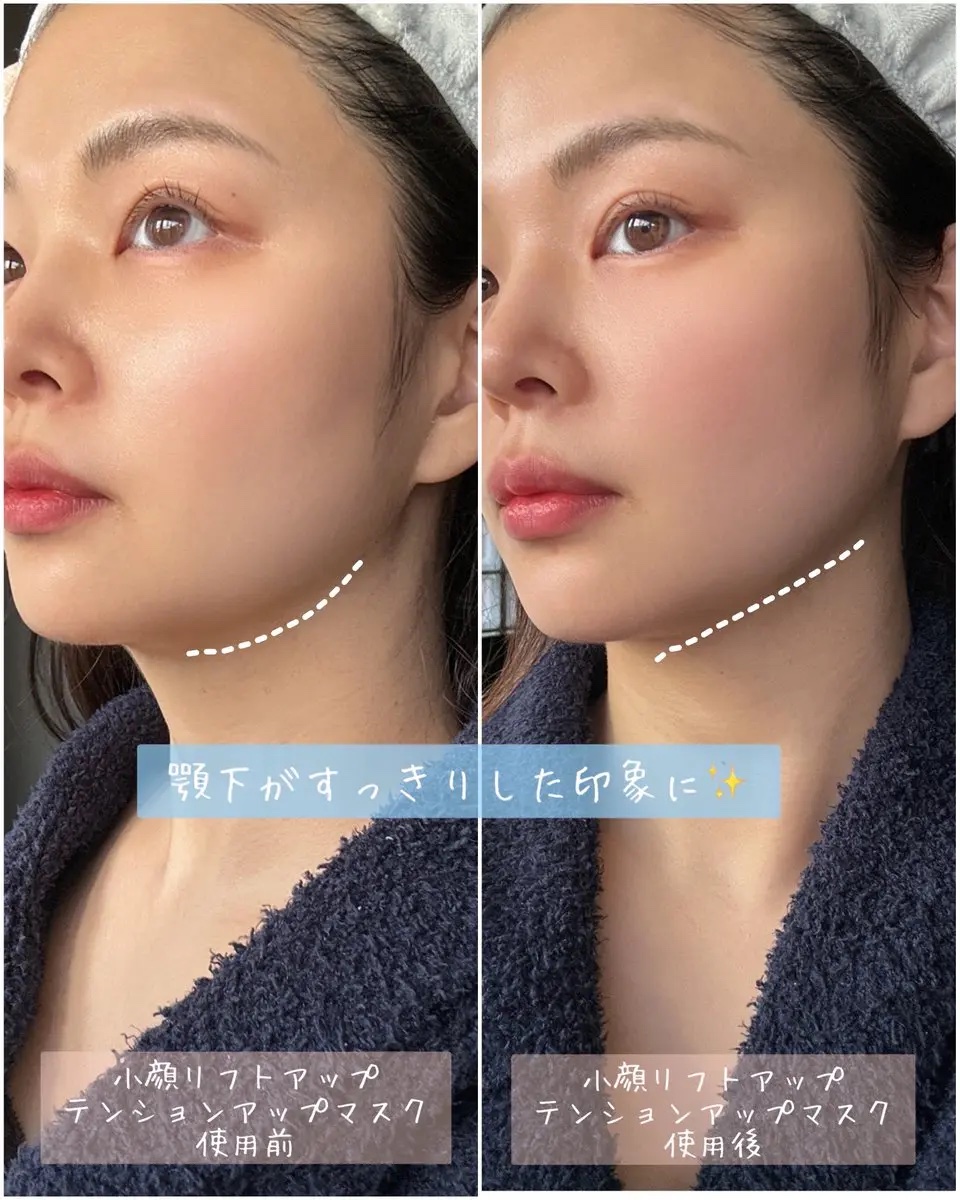 インモトックステンションアップマスク/MEDITHERAPY/シートマスク・パックを使ったクチコミ（3枚目）