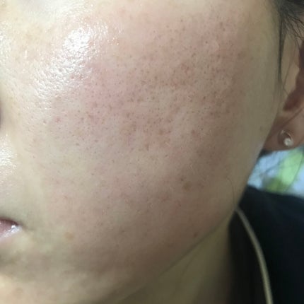 ゼロスポットパッチ/Today’s Cosme/にきびパッチを使ったクチコミ(2枚目)