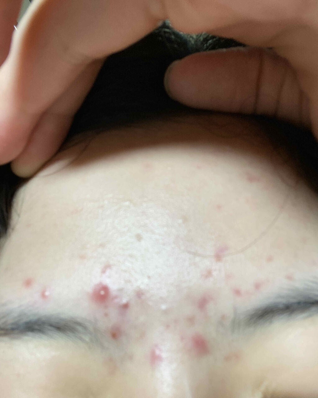 のの on LIPS 「閲覧注意です⚠️約3年間ニキビが治らないです。誰か治る方法を教..」(4枚目)