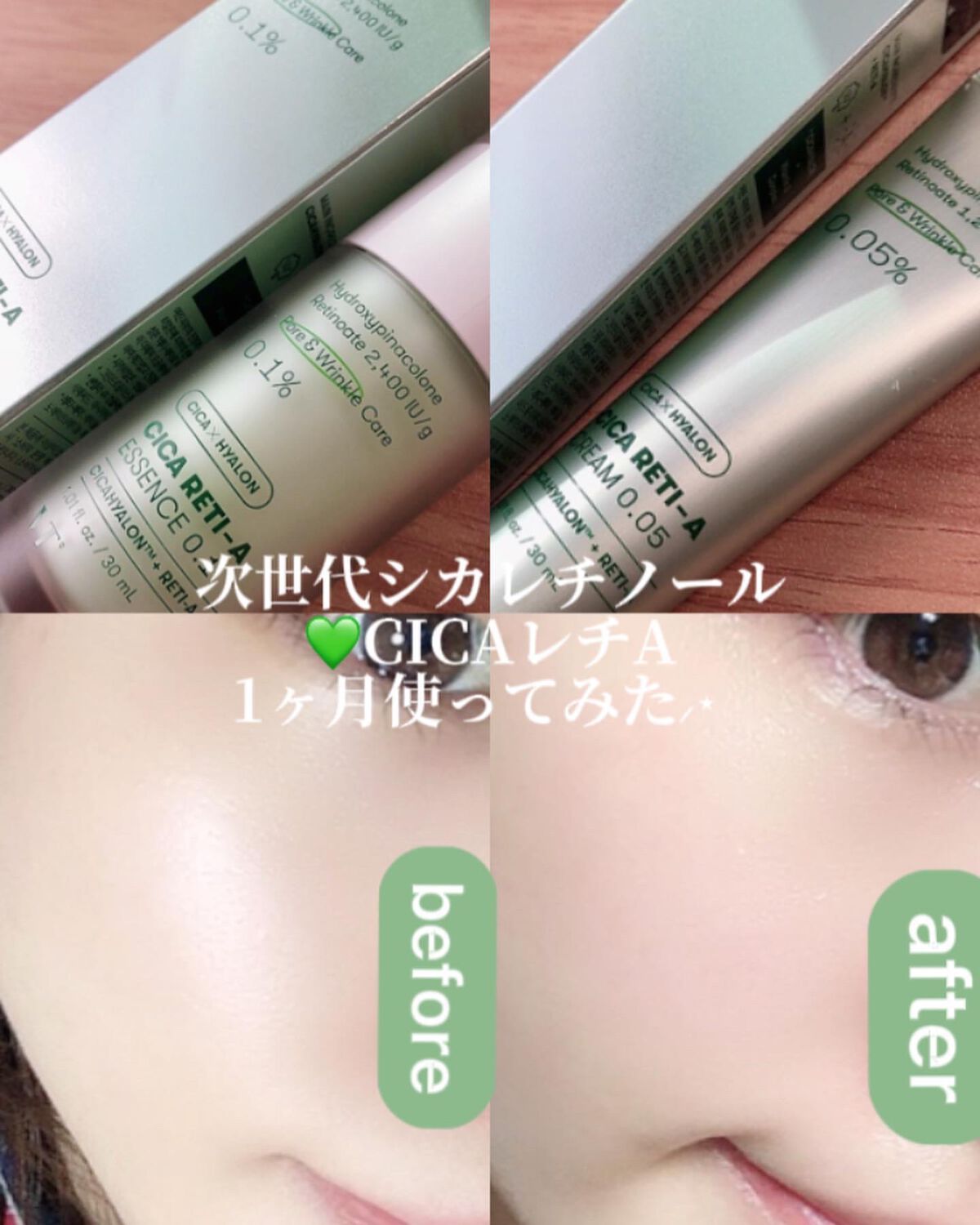 シカレチA クリーム0.05/VT/フェイスクリームを使ったクチコミ（2枚目）