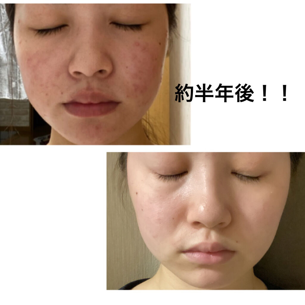 DHC 亜鉛/DHC/健康サプリメントを使ったクチコミ（1枚目）