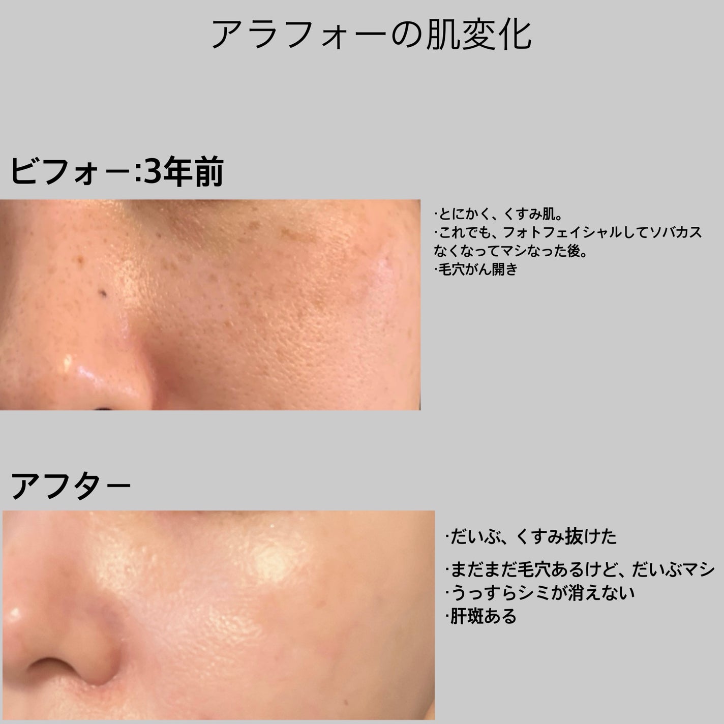 nyan on LIPS 「アラフォーの肌変化✨3年間で、やっとここまできましたー😭✨もち..」(1枚目)