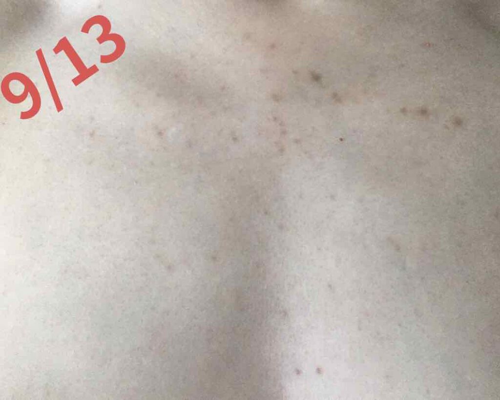 d プログラム dプログラム ホワイトニングクリア ジェリーエッセンスのクチコミ「自分用備忘録 Part2

土曜日2週間ぶりの診察👀

べピオゲル→❌  
クリンダマイシンゲ.....」（2枚目）