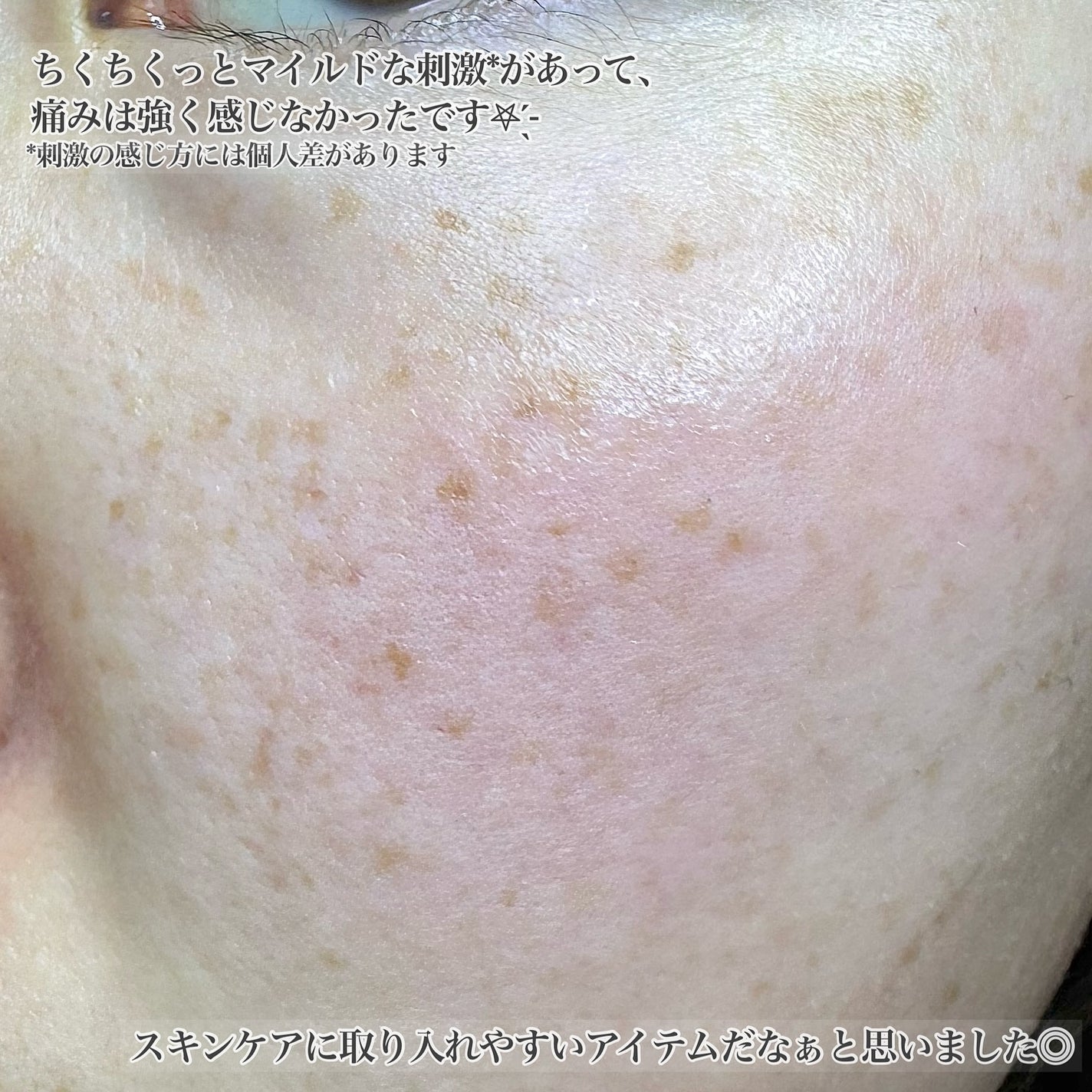 ニードルセラムAZ/fractionalCC/美容液を使ったクチコミ(4枚目)
