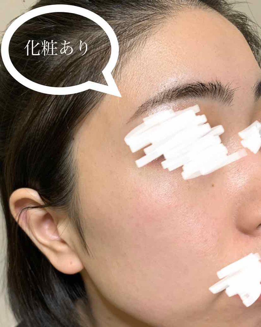 ビーソフテン ローション(医薬品)/持田製薬/その他を使ったクチコミ（2枚目）