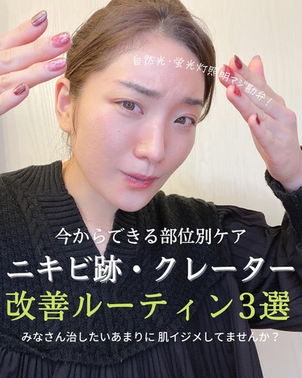 おゆみ|ニキビ・ニキビ跡ケア on LIPS 「【クレーターのケアは、段階があるので個別に相談乗っている方にお..」(1枚目)