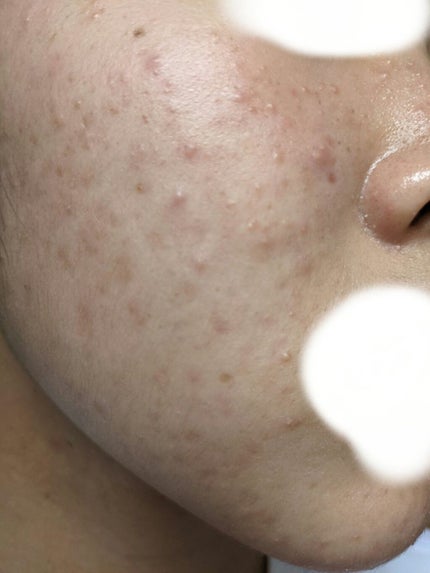 チョコラBBジュニア(医薬品)/チョコラBB/その他を使ったクチコミ(2枚目)