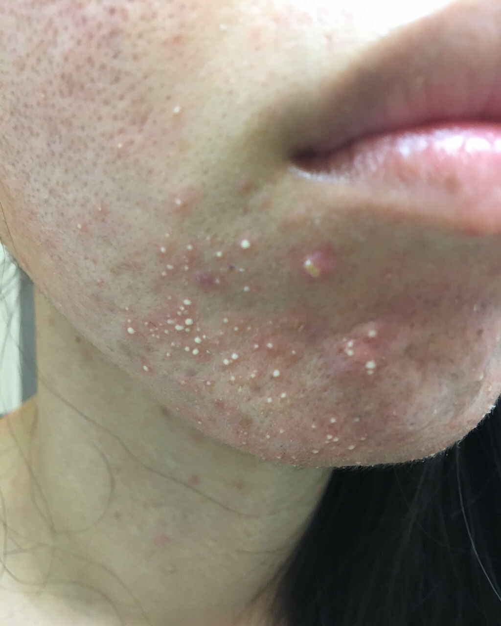 クロマイ-P軟膏AS(医薬品)/クロマイ/その他を使ったクチコミ（2枚目）