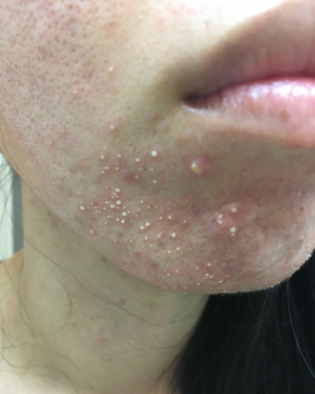 クロマイ-P軟膏AS(医薬品)/クロマイ/その他を使ったクチコミ(2枚目)