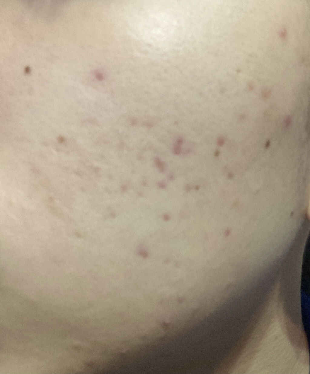 潤浸保湿 化粧水 III とてもしっとり/キュレル/化粧水を使ったクチコミ（1枚目）