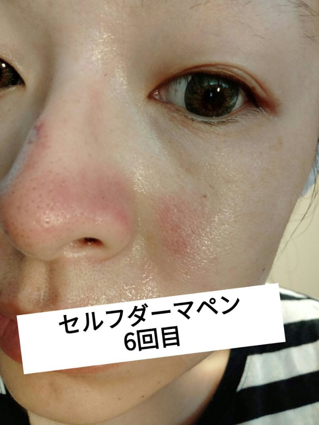 ダーマペン・ダーマスタンプ/MyM/その他スキンケアグッズを使ったクチコミ(1枚目)