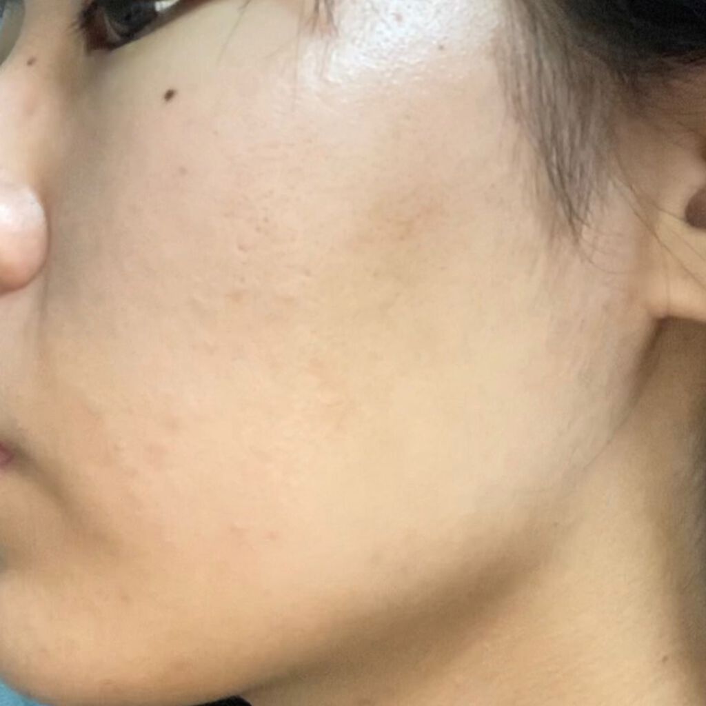 ハトムギ化粧水(ナチュリエ スキンコンディショナー R )/ナチュリエ/化粧水を使ったクチコミ（3枚目）