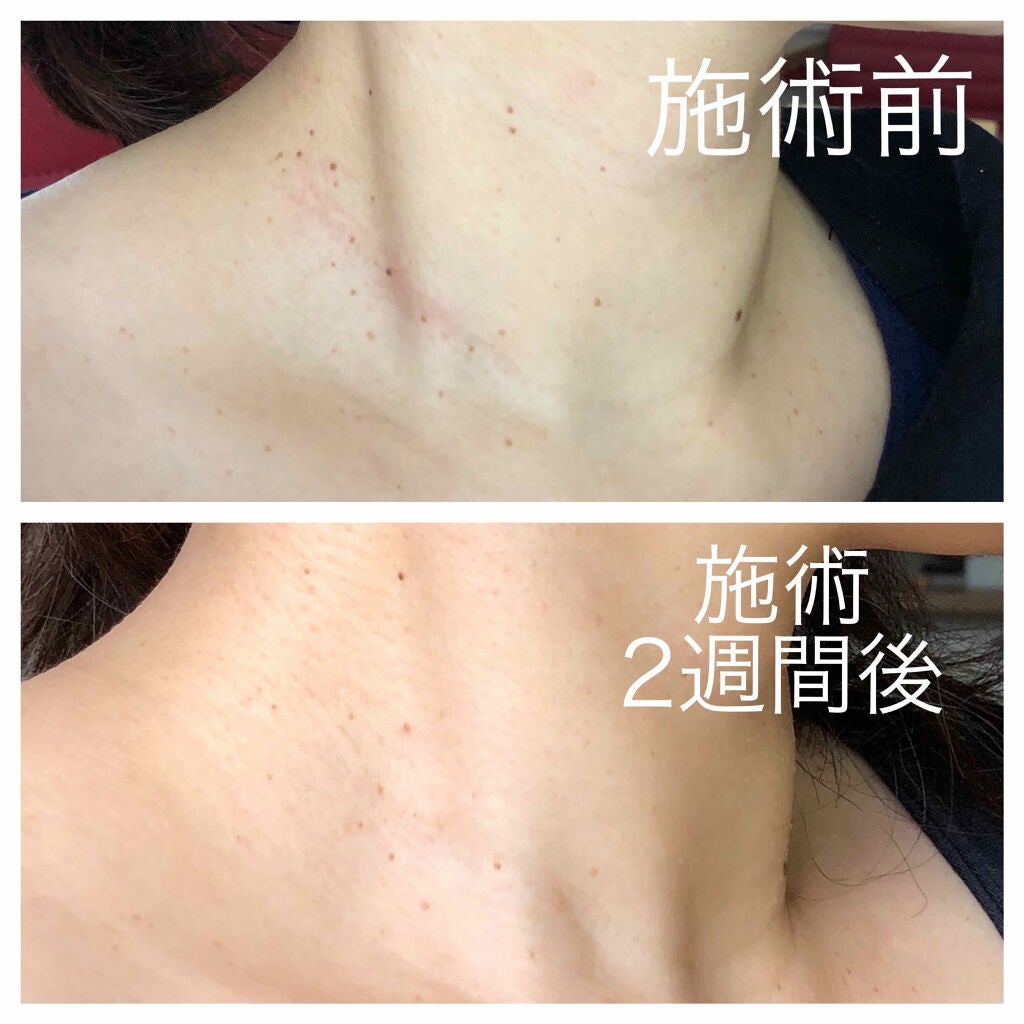 くろみ on LIPS 「⚠️症例写真あります⚠️苦手な方はご注意下さい⚠️30代を迎え..」(4枚目)