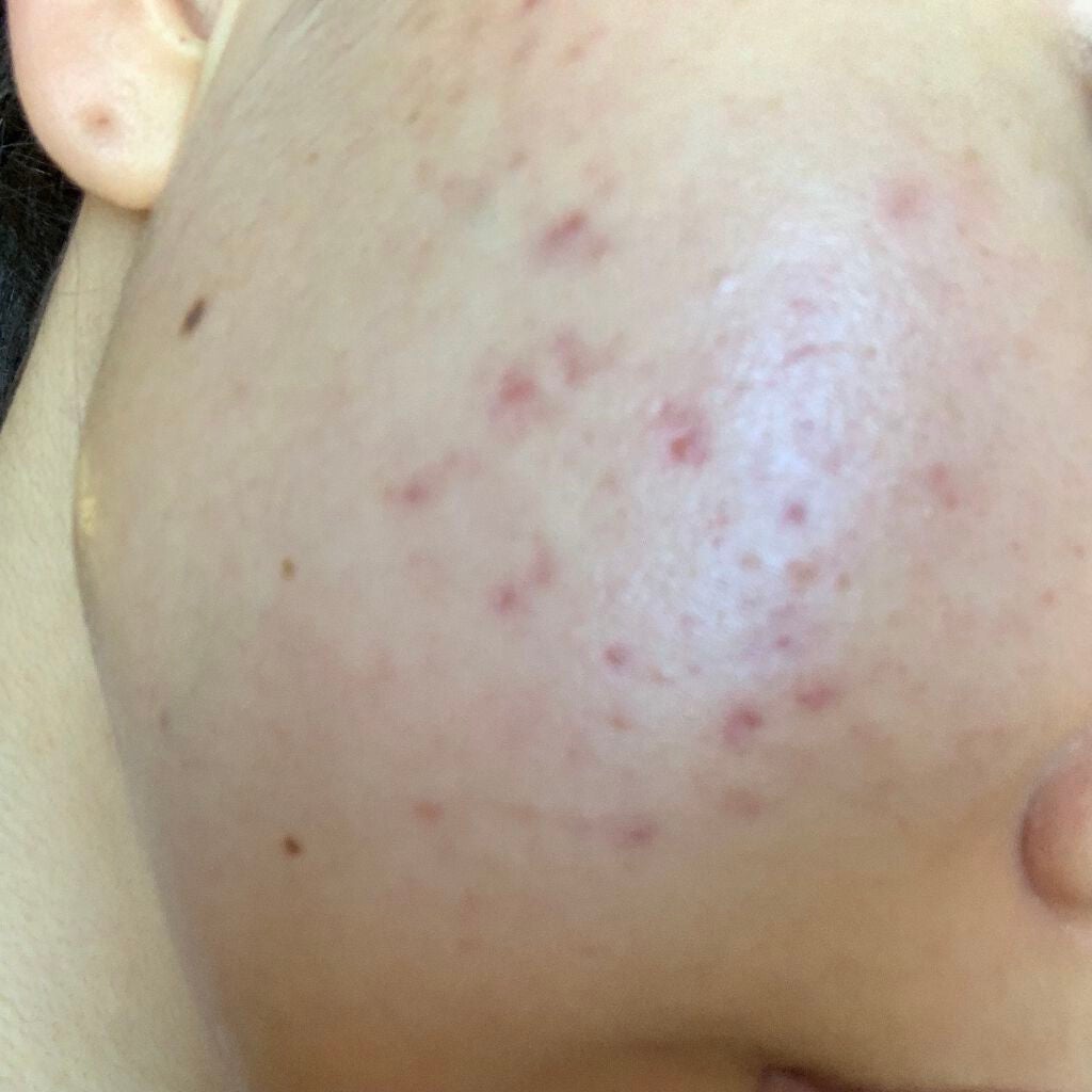 space on LIPS 「まあまあマシになってきてるかな🥺やっぱり夜が痛みます🥺で!も!..」(2枚目)