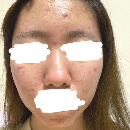 Mちゃん on LIPS 「⚠️閲覧大注意⚠️肌が本当に汚いので苦手な方はご遠慮ください🙇..」(4枚目)