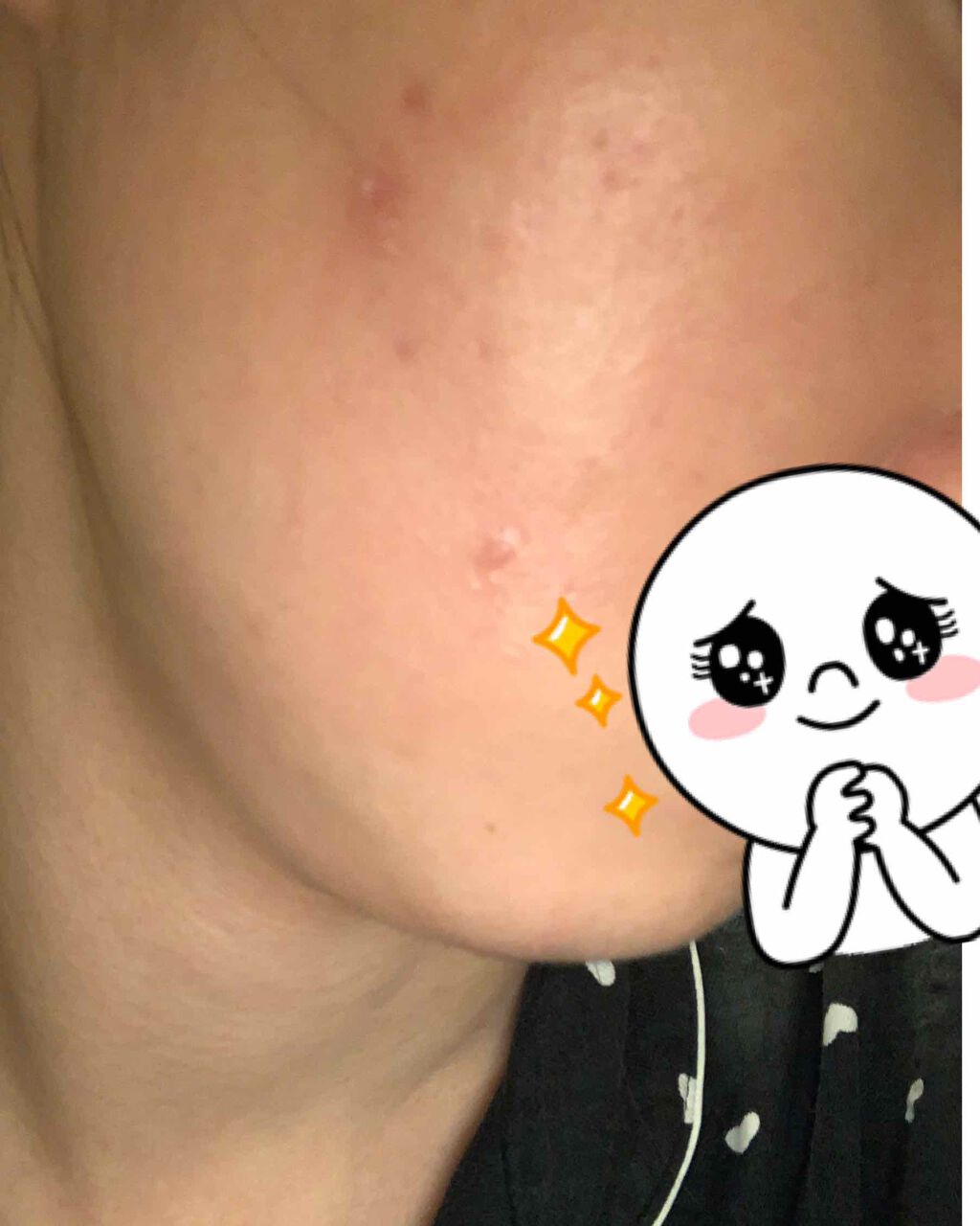 ペアアクネクリームW(医薬品)/ペア/その他を使ったクチコミ（1枚目）