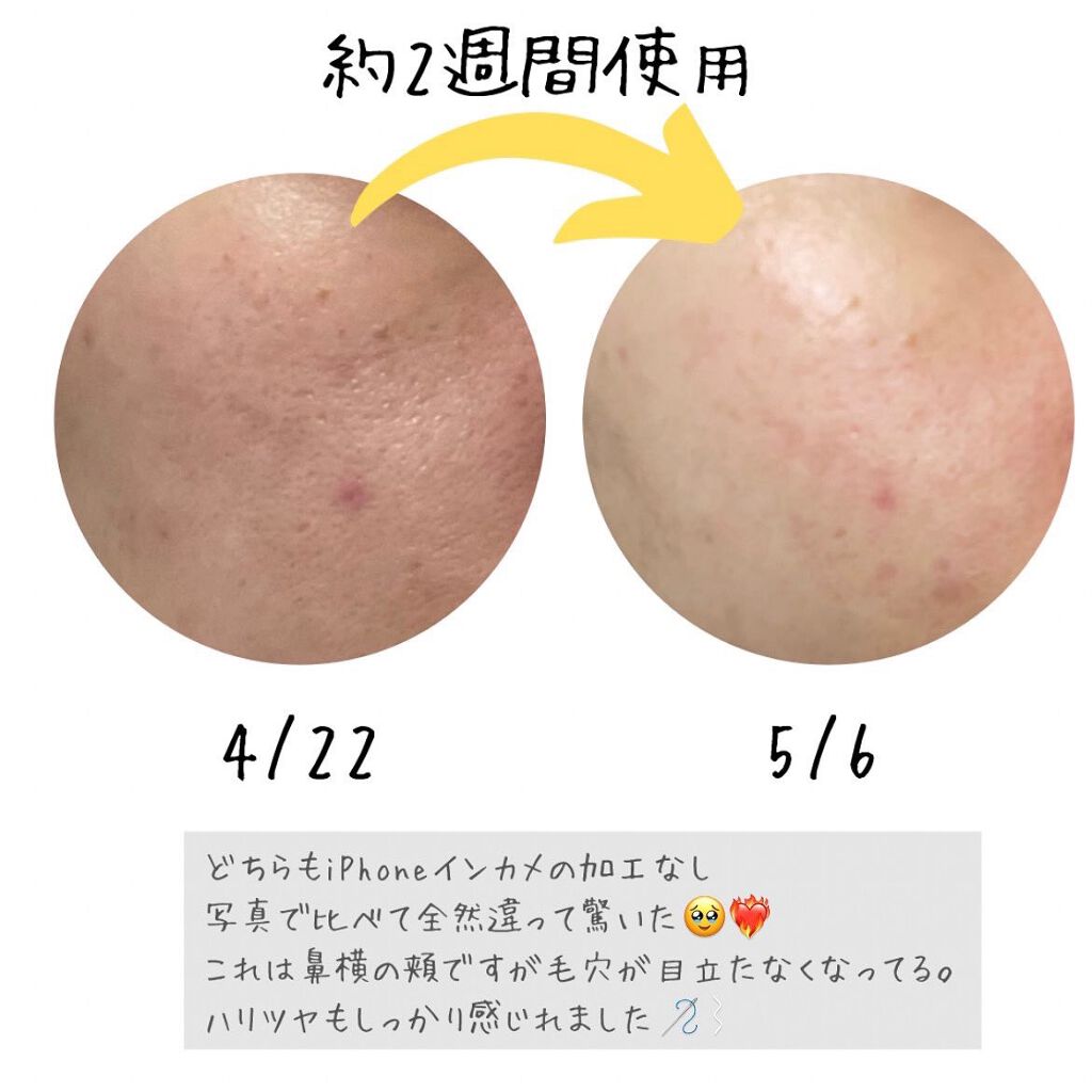 タカミスキンピール/タカミ/ブースター・導入液を使ったクチコミ（2枚目）