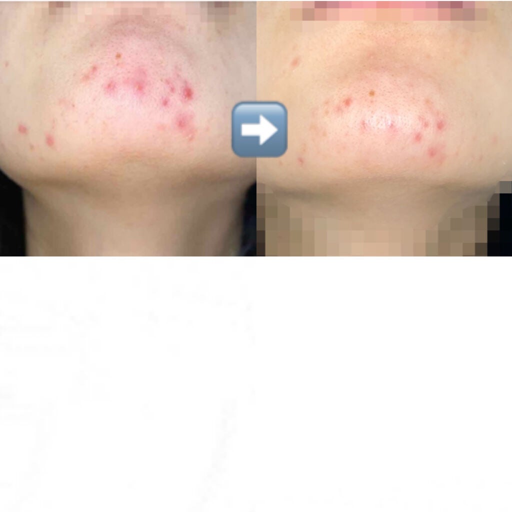 オキシドール(医薬品)/日本薬局方/その他を使ったクチコミ(3枚目)