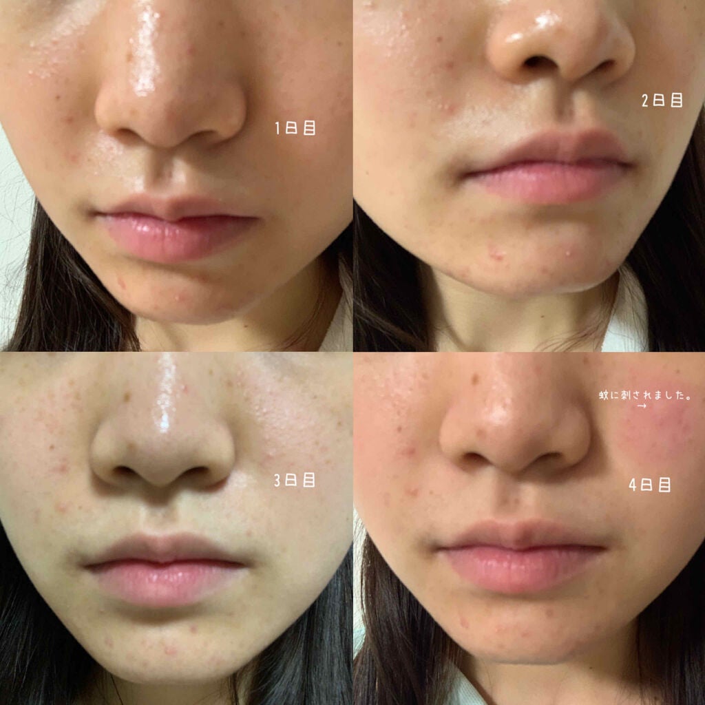 ð°ð· on LIPS ããããæ²æ»
ã®ãã30æ¥éããã¿ãã³Cãšãã¿ãã³Bã飲ã¿ç¶ããæ°Ž..ãïŒ2æç®ïŒ